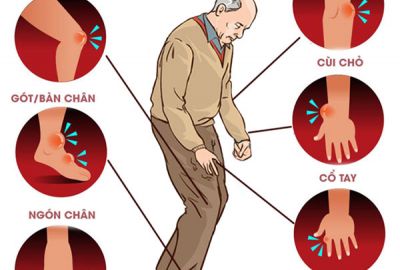 Có gì trong các loại TPCN phòng và điều trị bệnh gout?